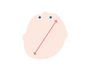 斜頭症のイメージ