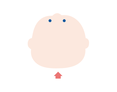 短頭症（絶壁頭）のイメージ