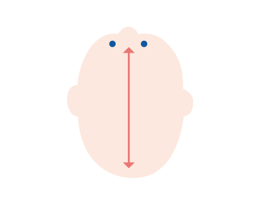 長頭症のイメージ