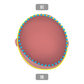 ヘルメット治療前後の比較