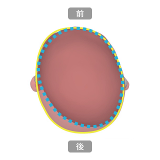 ヘルメット治療前後の比較