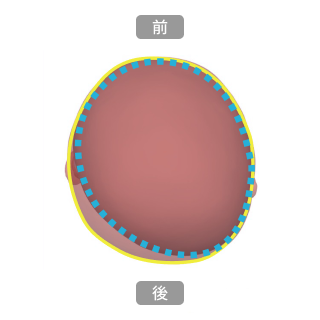 ヘルメット治療前後の比較