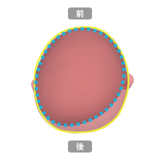 ヘルメット治療前後の比較
