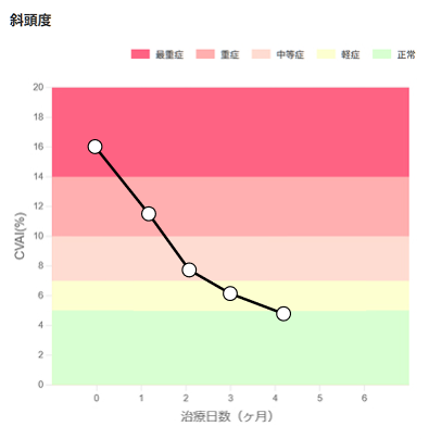 斜頭度（左右非対称の形）のイメージ