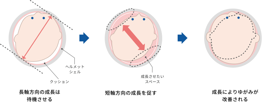 長軸方向の成長は待機させる→短軸方向の成長を促す→成長によりゆがみが改善される