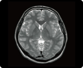 脳（大脳）のMRI検査の症例画像