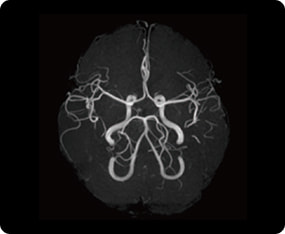 血管（MRA）の症例画像