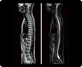 脊髄のMRI検査の症例画像