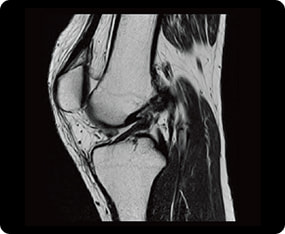 膝関節のMRI検査の症例画像