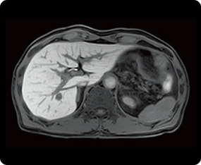腹部のMRI検査の症例画像